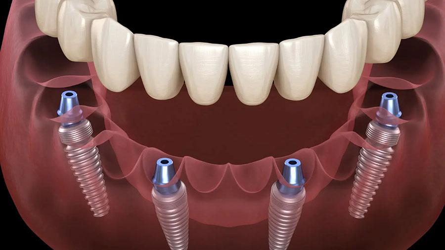 All on 4 – 4 trụ implant cho toàn hàm All on 4 – 4 trụ implant cho toàn hàm