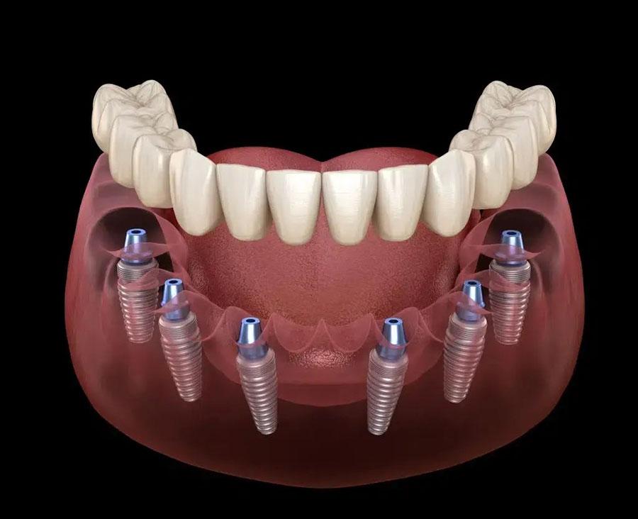 All on 6 – 6 trụ implant cho toàn hàm All on 6 – 6 trụ implant cho toàn hàm