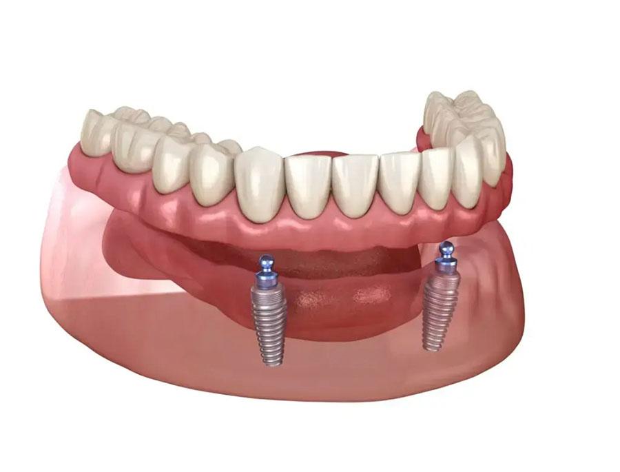 All on 2 – Hàm giả tháo lắp trên 2 trụ implant All on 2 – Hàm giả tháo lắp trên 2 trụ implant