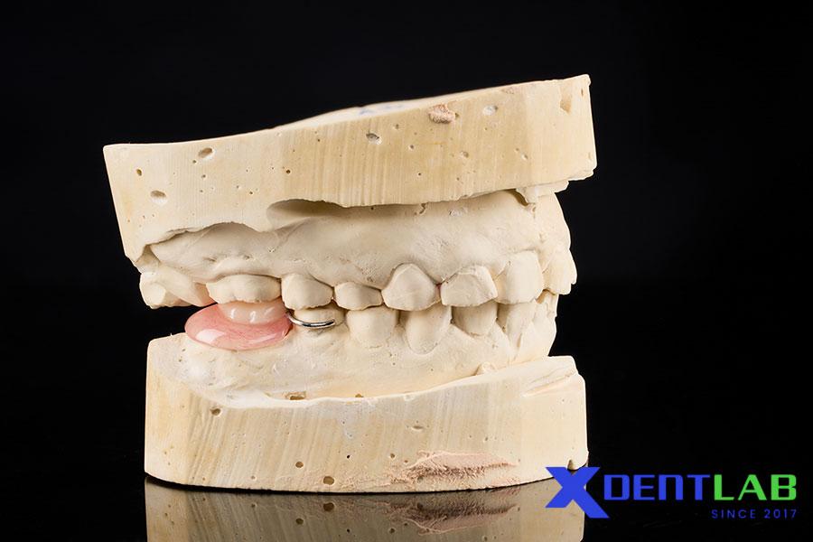 Tương Lai của Răng Tháo Lắp Tương Lai của Răng Tháo Lắp