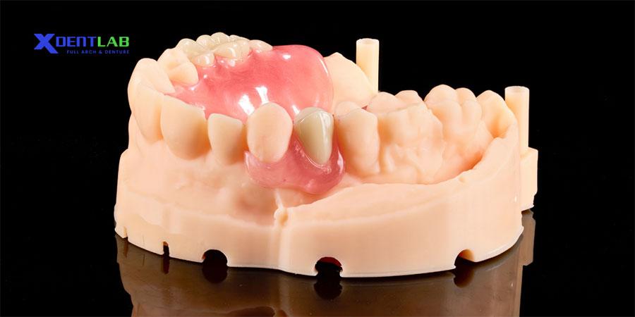 Why Dental Labs Choose Valplast?