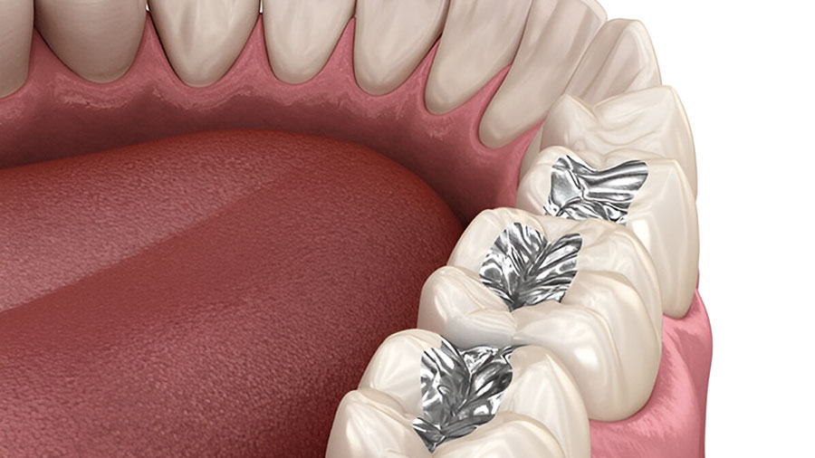 Amalgam: Comprehensive Overview From A U.S. Dental Lab Perspective Amalgam: Comprehensive Overview From A U.S. Dental Lab Perspective