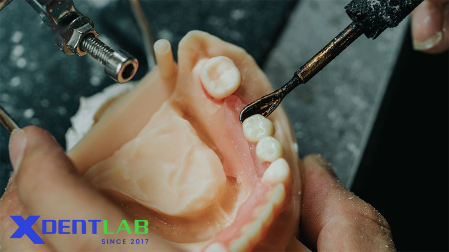 Why Choose XDENT LAB for Denture Lab-to-lab Service? Why Choose XDENT LAB for Denture Lab-to-lab Service?
