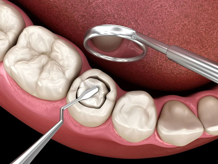 Dental Composites Dental Composites