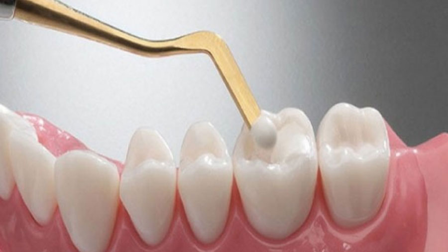 Glass Ionomer Cements Glass Ionomer Cements