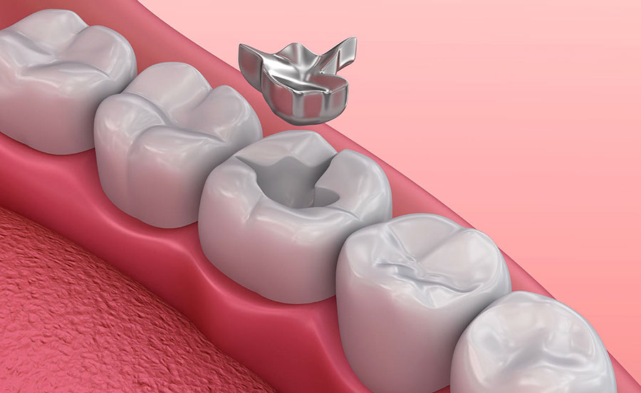 Amalgam Amalgam