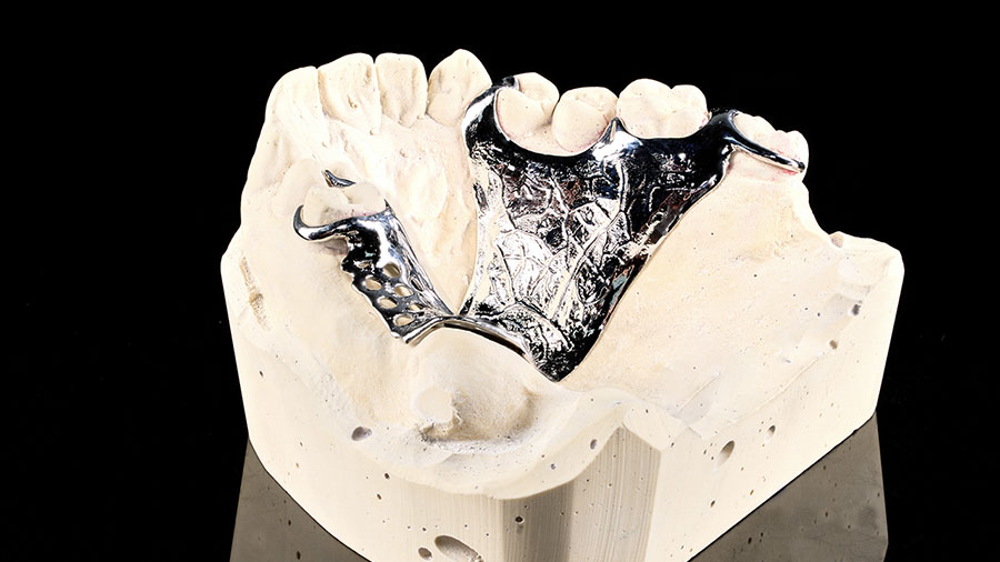 Framework Materials In Dentistry: A Comprehensive Overview