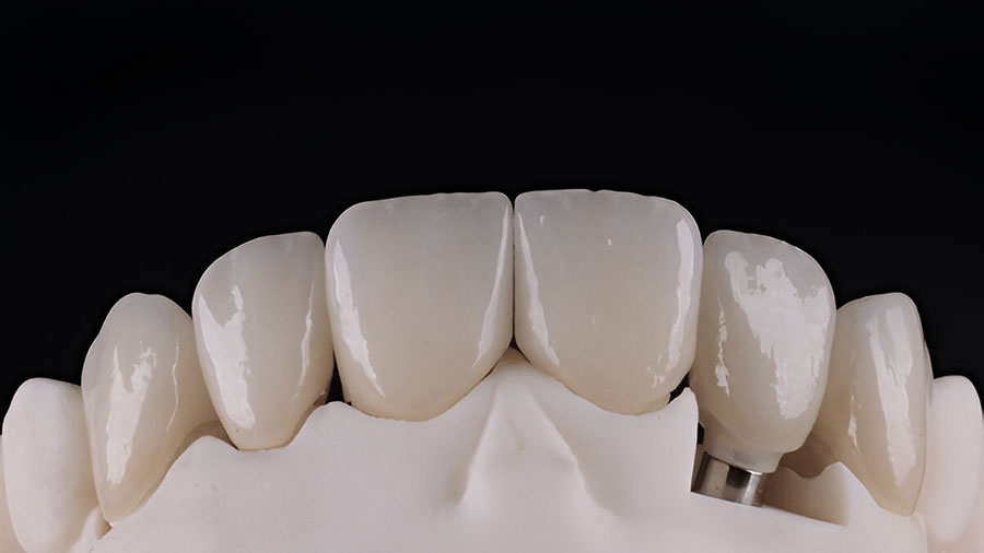 Lithium Disilicate (E.max) In Dental Ceramic Frameworks: A Comprehensive Analysis Lithium Disilicate (E.max) In Dental Ceramic Frameworks: A Comprehensive Analysis