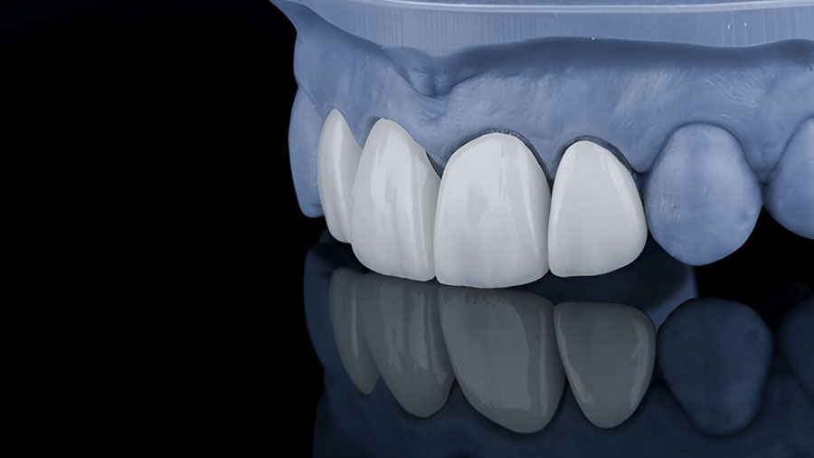 Glass-Infiltrated Alumina (In-Ceram Alumina): A Comprehensive Guide For Dental Professionals Glass-Infiltrated Alumina (In-Ceram Alumina): A Comprehensive Guide For Dental Professionals
