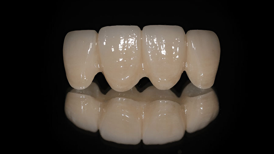 How Multi-Layered Zirconia Revolutionizes Dental Ceramic Frameworks How Multi-Layered Zirconia Revolutionizes Dental Ceramic Frameworks
