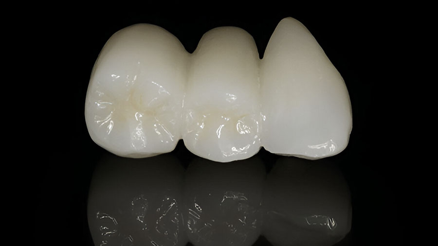 How Procera AllCeram Ensures Precision And Strength In Dental Restorations