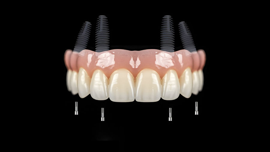 Polyetherketoneketone (PEKK): Revolutionizing Dental Prosthetics Polyetherketoneketone (PEKK): Revolutionizing Dental Prosthetics