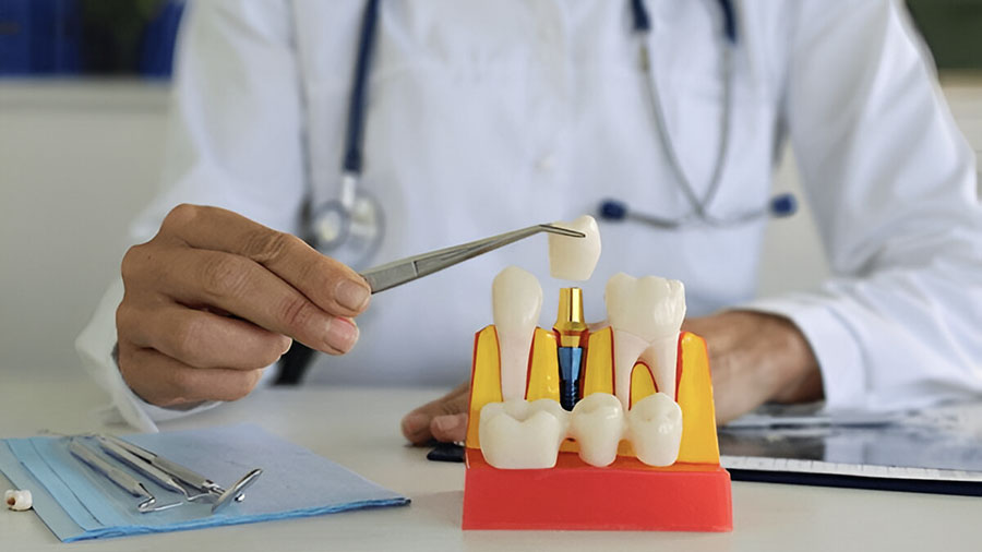 Dental Implant Materials: Titanium vs Zirconia - A Comprehensive Review