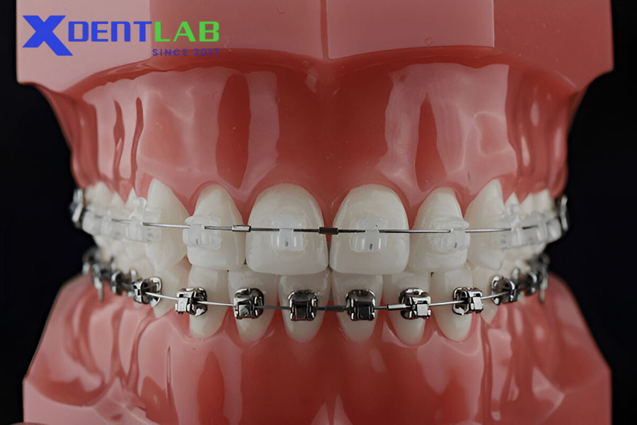Orthodontic Wires Orthodontic Wires