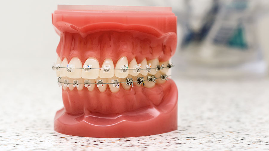 Stainless Steel Wires: From Composition To Clinical Use