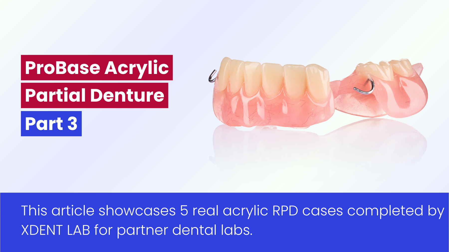 Phục hình tháo lắp bán phần nhựa cứng từ Dental Lab Việt Nam - Dịch vụ gia công ( Phần 3)