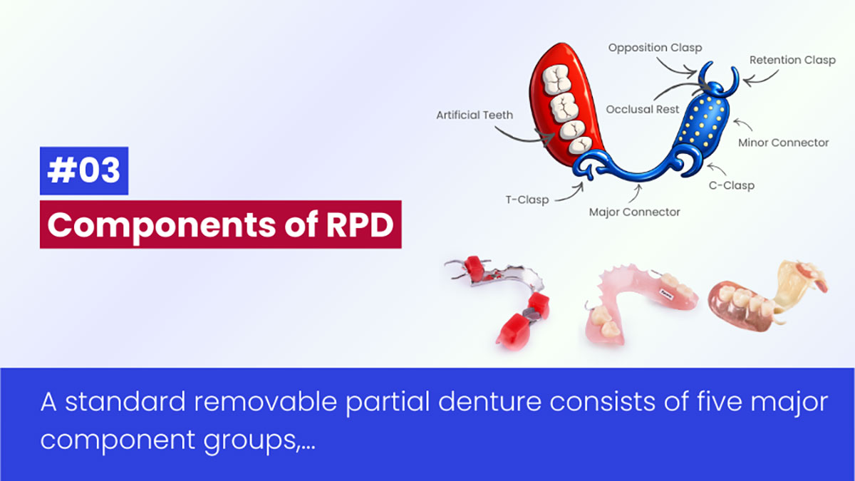 Các Thành Phần Của Hàm Tháo Lắp Bán Phần – Phân Tích Thiết Kế RPD Trong Phục Hình Răng
