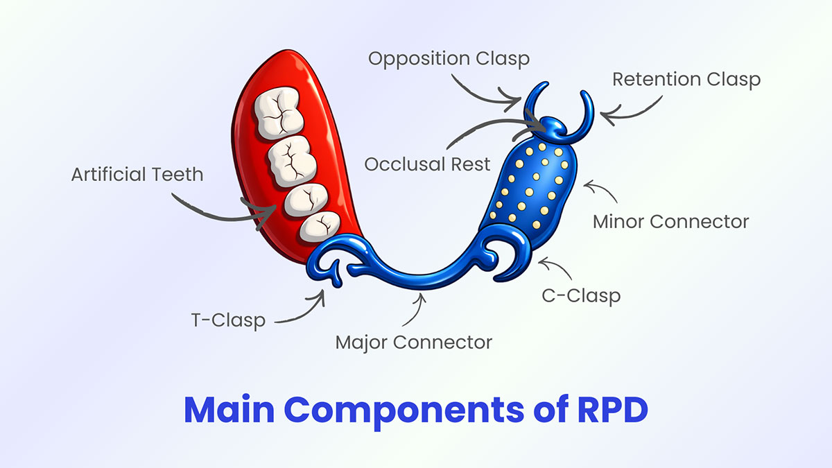 Components Of RPD An Analysis Of Removable Partial Denture Design In 