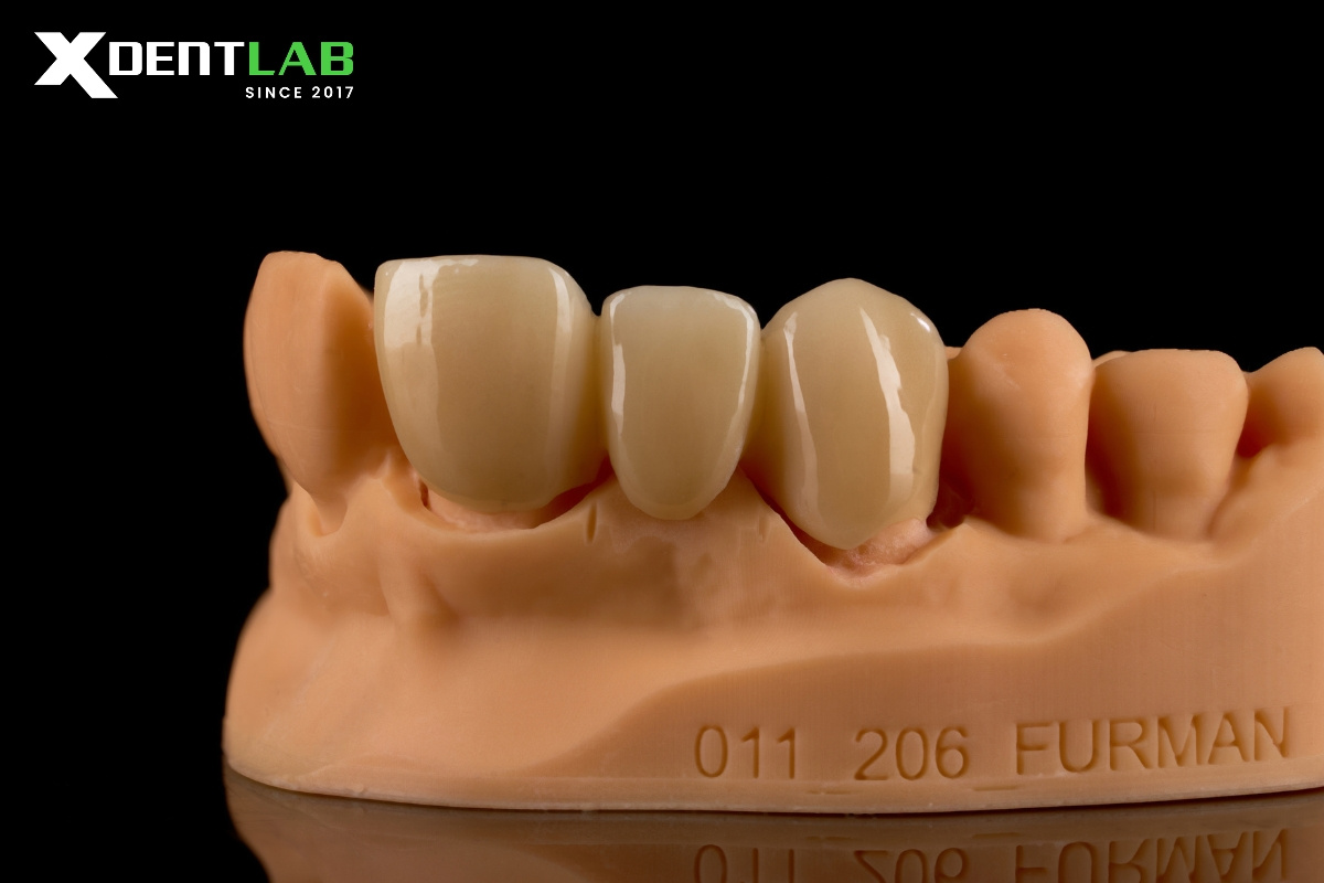 What Is A Full Zirconia Crown? What Is A Full Zirconia Crown?