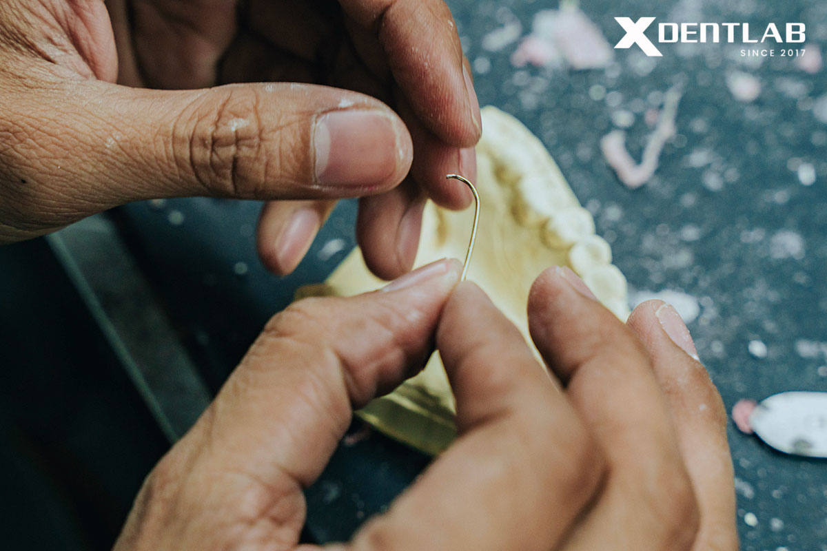 Common Stress-Breaking Methods in RPDs