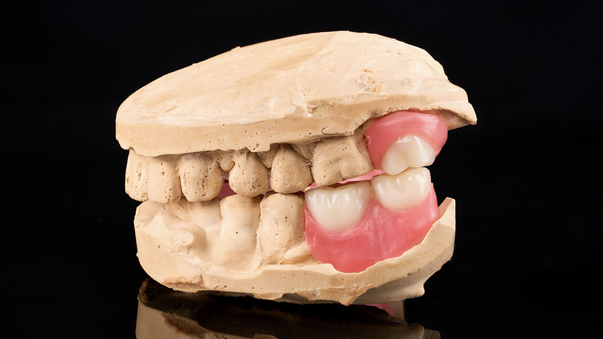 Chemical-Cured Acrylic Resin Denture Bases: Uses, Strengths, Limitations, And ISO/FDA Best Practices