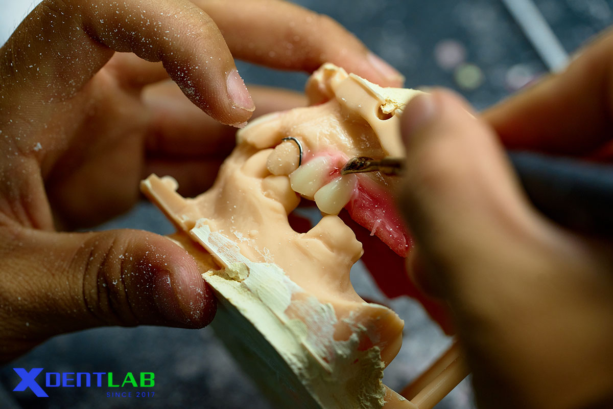Clasps are one of the most important components in removable partial dentures (RPDs)