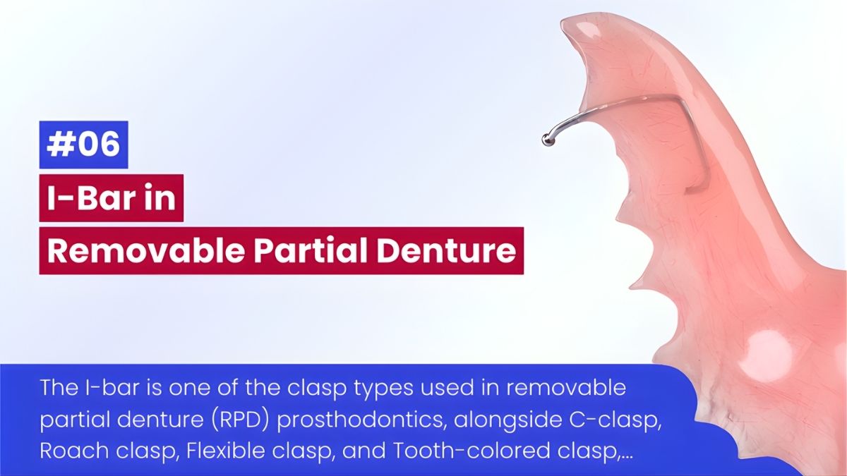 Móc I-Bar Trong RPD: Thiết Kế, Chức Năng Và Ứng Dụng Lâm Sàng