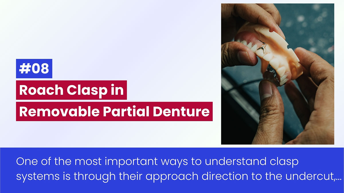 Móc Roach Trong Hàm Giả Bán Phần Tháo Lắp: Hướng Dẫn Toàn Diện Dựa Trên Phân Loại Móc Giữ