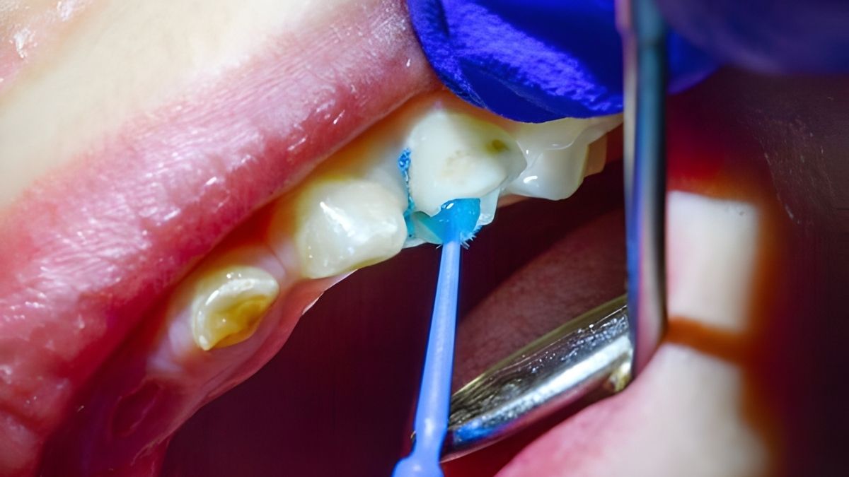 Chỉ định, chống chỉ định và kỹ thuật