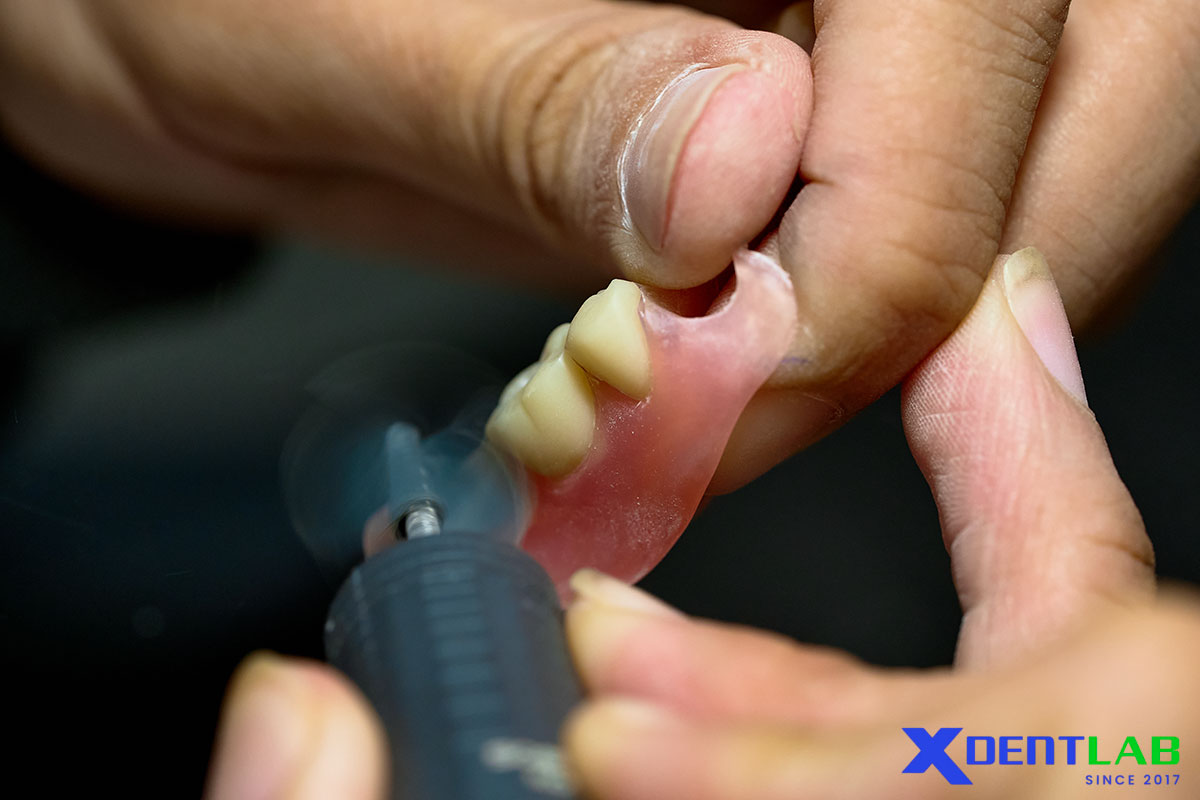 Comparison Of Nylon And Polyolefin Materials In Flexible Dentures