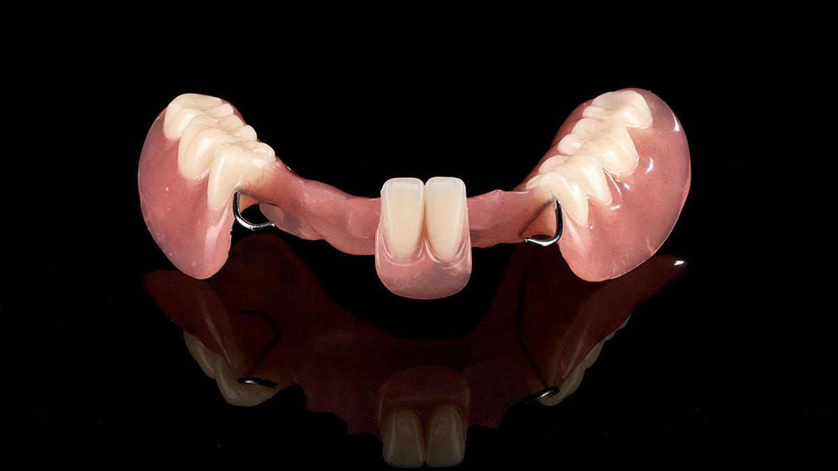 Kennedy Classification Of RPDs: Design, Load Paths, And Risk Control