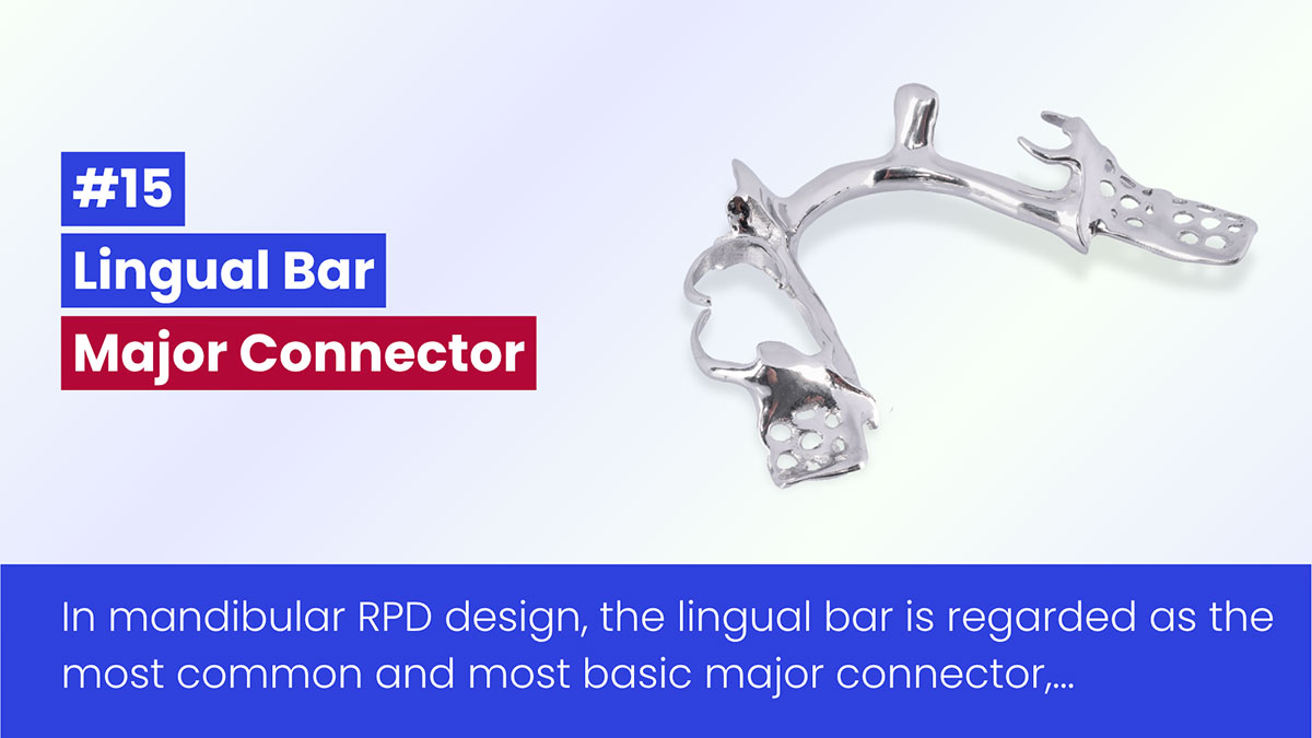 Lingual Bar In RPD: Design, Indications, And Limitations