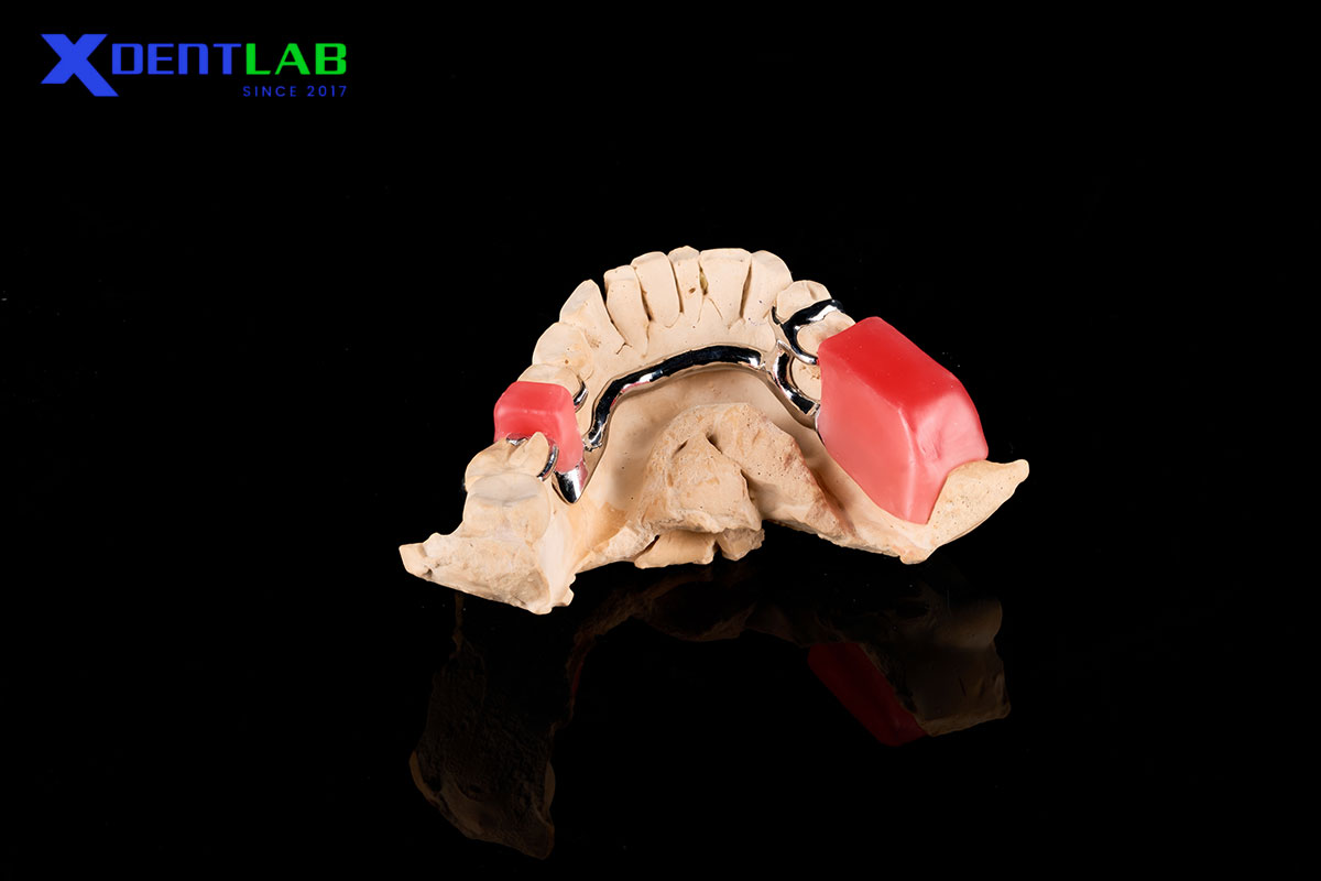 What Is a Lingual Bar in RPD? What Is a Lingual Bar in RPD?