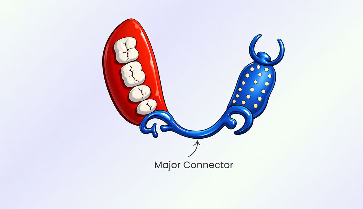 What Is a Major Connector in RPD?