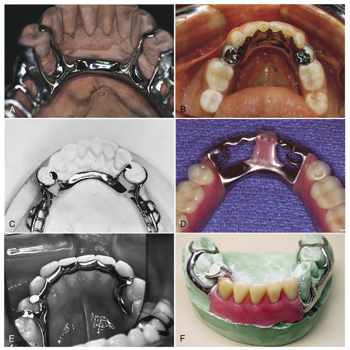 Types of Mandibular Major Connectors in RPD