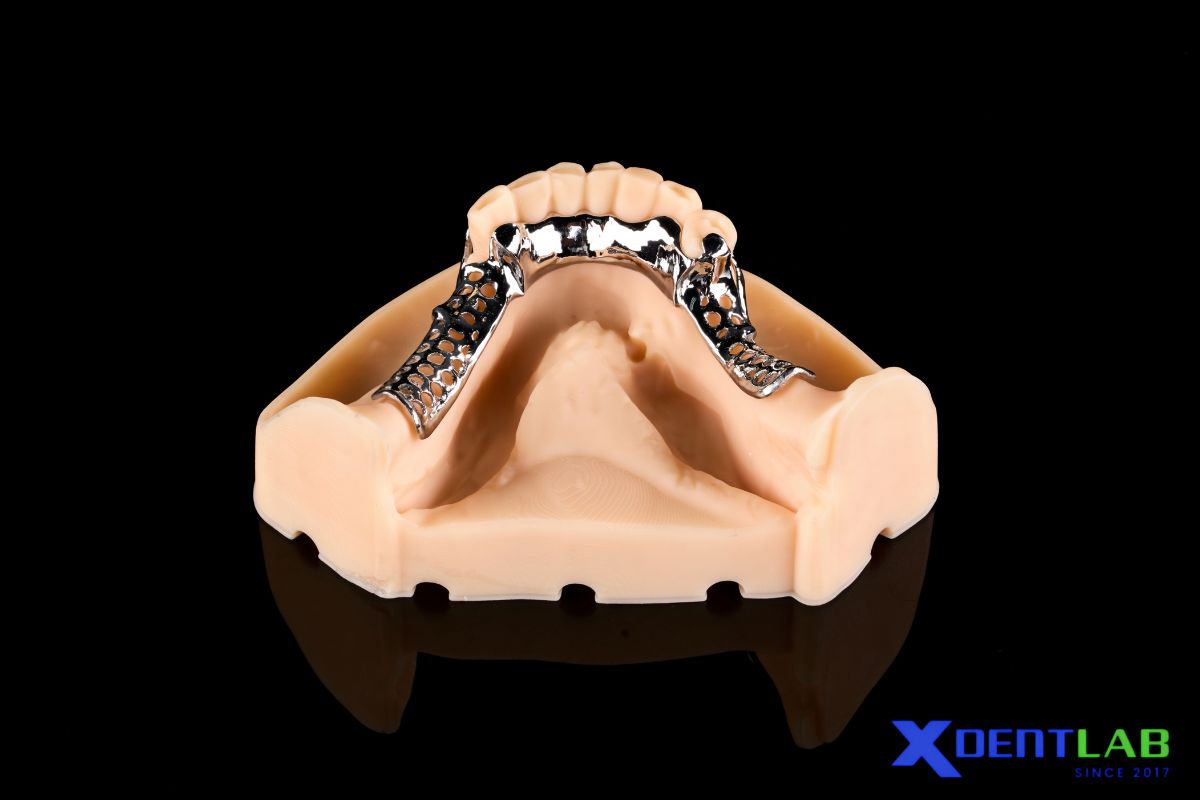When Is a Linguoplate Indicated?