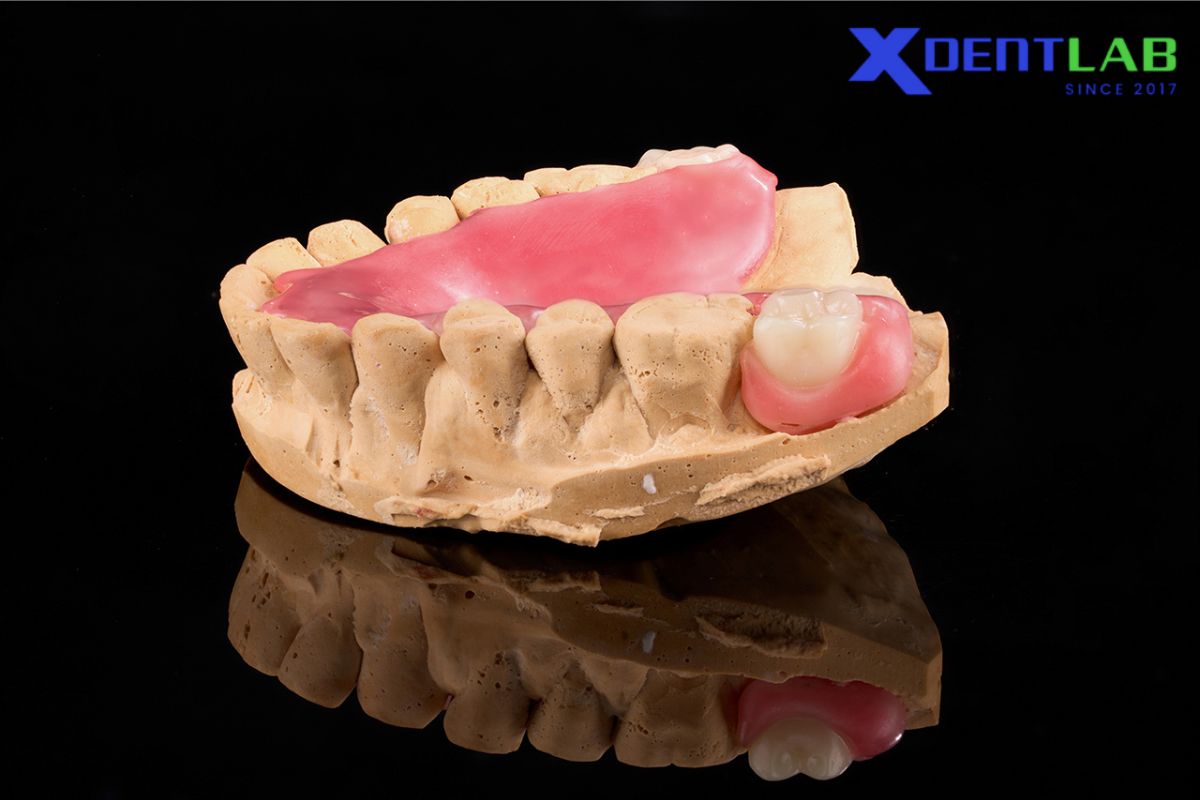 Main applications of polyamides in dentistry