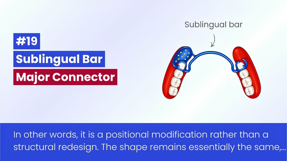 Sublingual Bar In RPD: Design, Indications, And Limitations