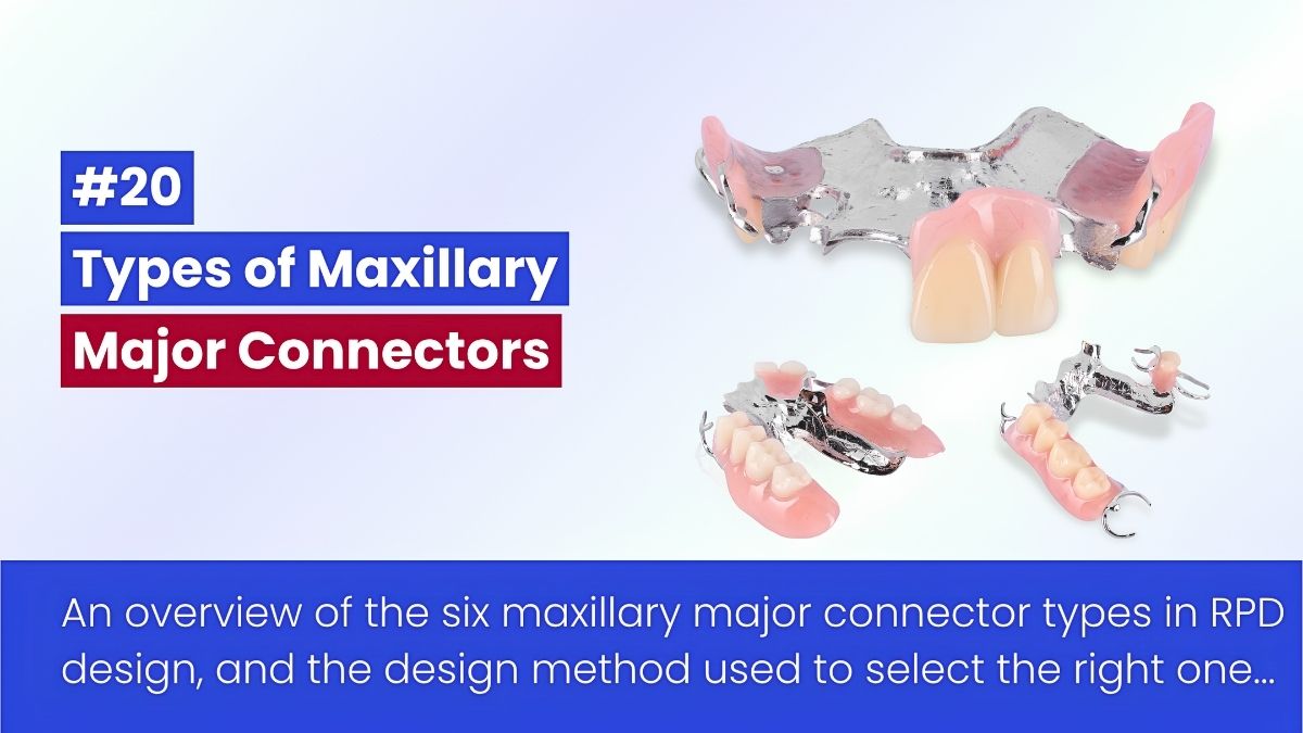 Maxillary Major Connectors In Removable Partial Denture