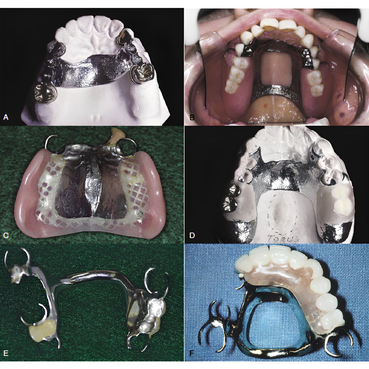 Six Types of Maxillary Major Connectors Six Types of Maxillary Major Connectors