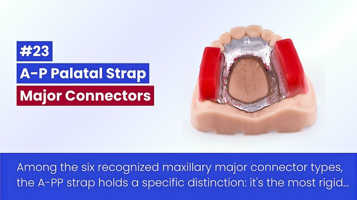 The Combination Anterior-Posterior Palatal Strap In RPD