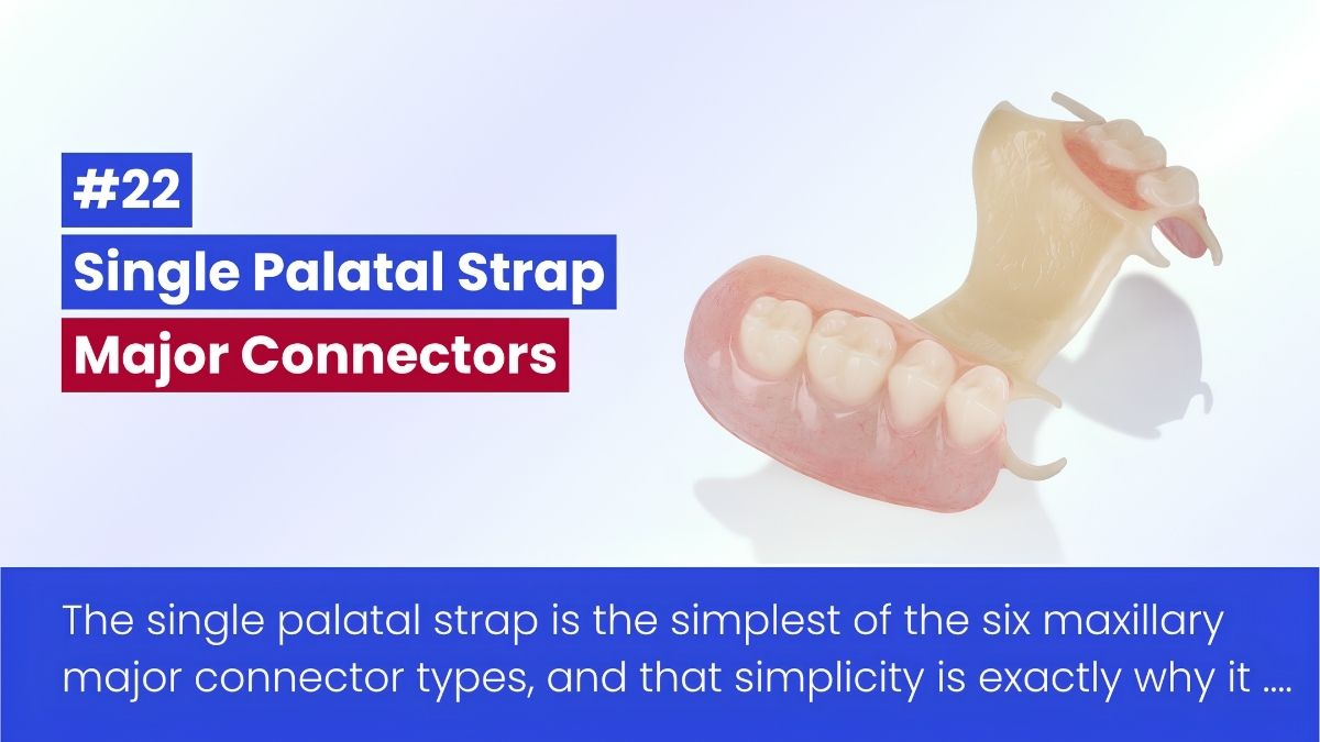 The Single Palatal Strap In RPD
