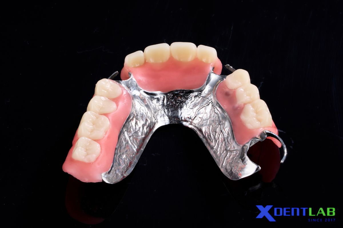 The U-shaped palatal connector isn't a poor design so much as a narrowly scoped one The U-shaped palatal connector isn't a poor design so much as a narrowly scoped one