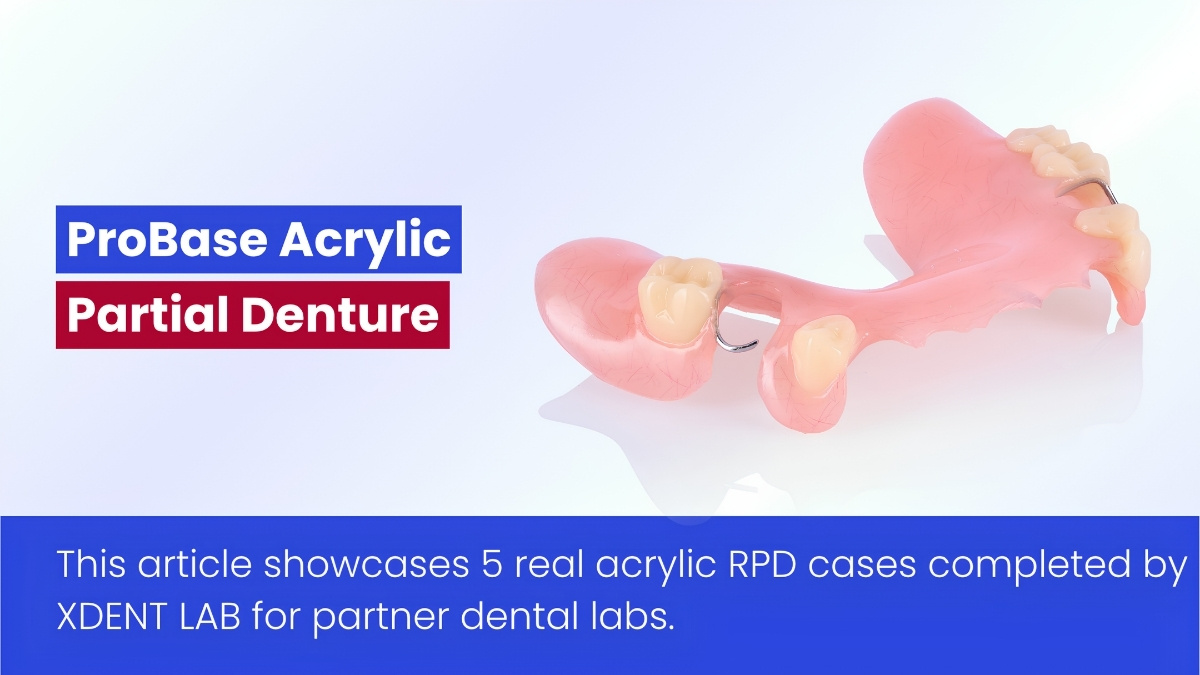 Acrylic Removable Partial Denture Photos By Vietnam Dental Laboratory