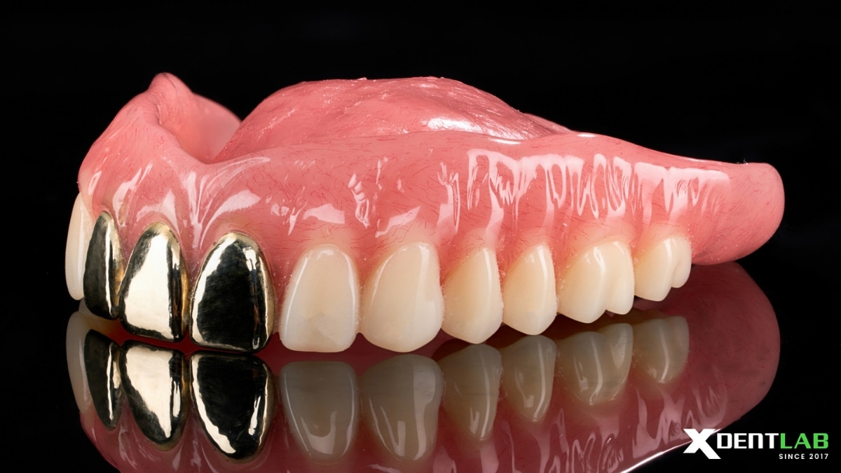 Case 3: Maxillary Complete Denture Combined with Gold Cast Teeth Case Case 3: Maxillary Complete Denture Combined with Gold Cast Teeth Case