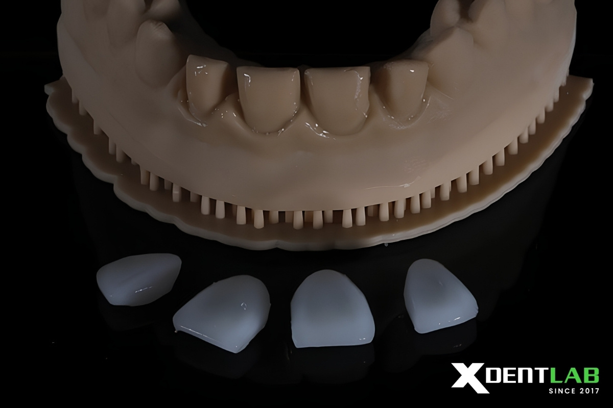 Types of veneers Types of veneers
