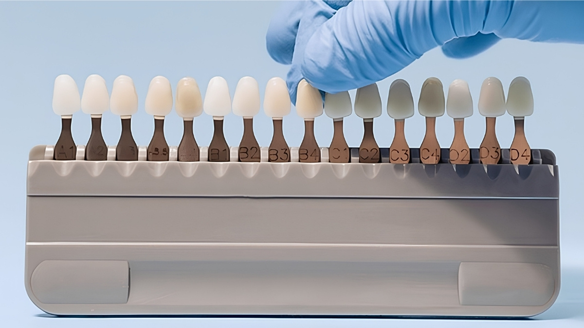 Shade selection for veneers Shade selection for veneers