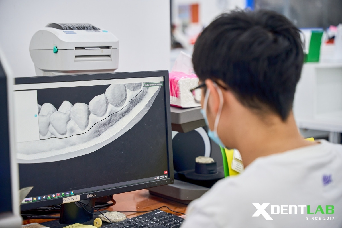 Digital veneers and CAD/CAM Digital veneers and CAD/CAM