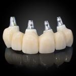 Cemented Implant Crown & Bridge