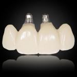 Cemented Implant Crown & Bridge